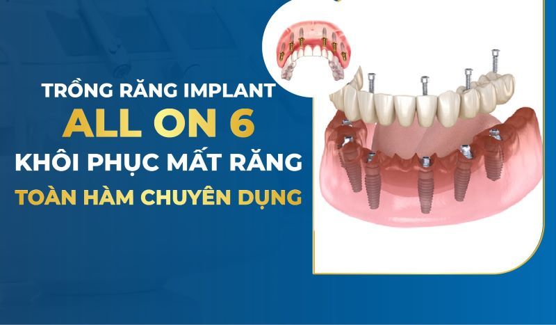 Nha khoa Parkview Dental chuyên sâu Implant All-on-6