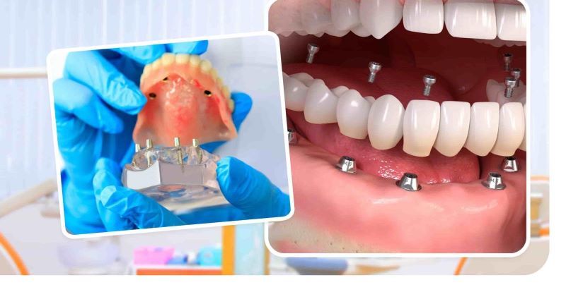 địa chỉ trồng răng implant tốt uy tín Phường Tân Định TPHCM 2