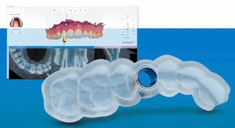 True Dental ứng dụng máng định vị AI tiên tiến