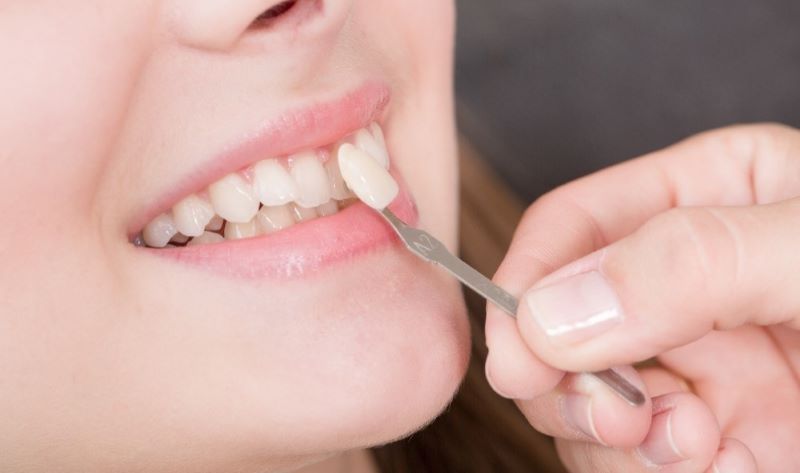 nha khoa bọc răng sứ giá rẻ tốt uy tín Phường Tân Sơn Nhì TP HCM 5