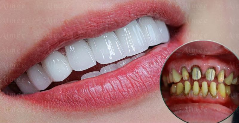 Răng sứ đều đẹp, trắng sáng sau phục hình tại SAIDO