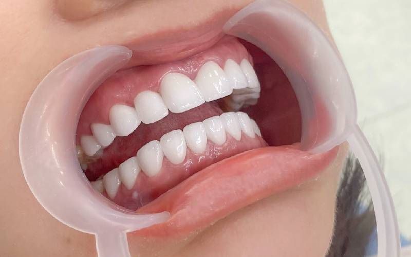 Khách hàng hài lòng sau khi bọc răng sứ tại Thiên Sứ