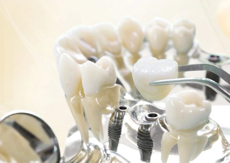 địa chỉ trồng răng implant tốt uy tín Phường Cầu Ông Lãnh TPHCM
