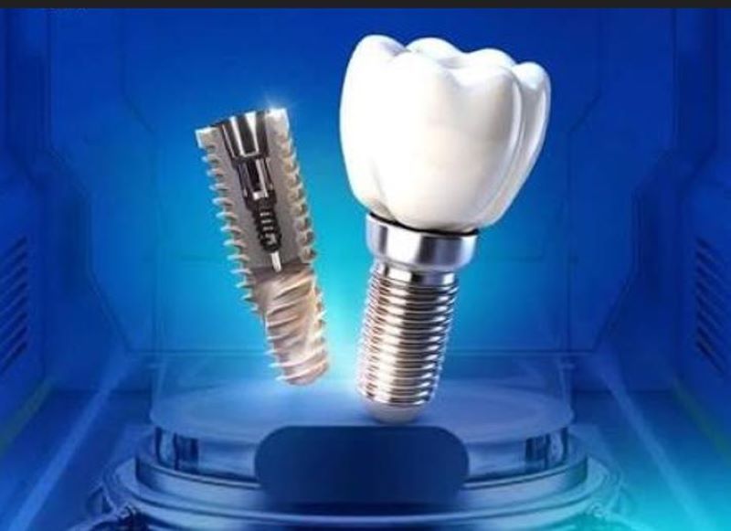 Nha Khoa MIC đa dạng lựa chọn trụ Implant