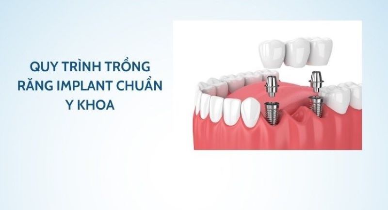 Nha Khoa DR Vương quy trình điều trị chuẩn y khoa
