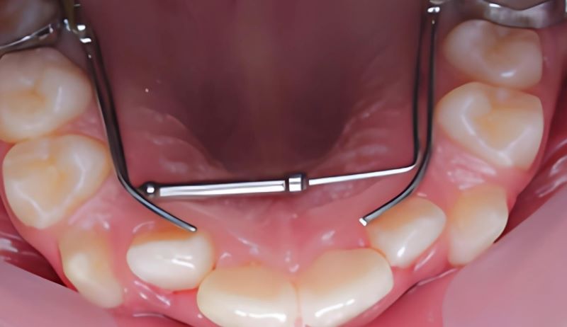 Khí cụ nong rộng hàm