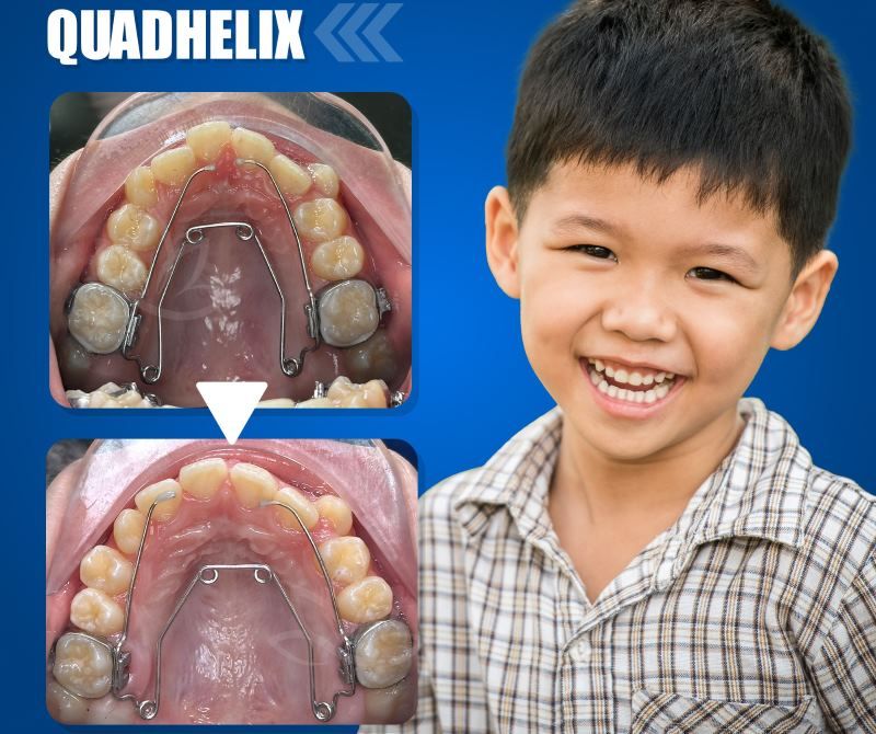 Khí cụ nong rộng hàm 3