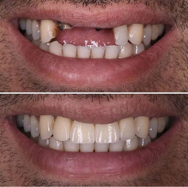 nha khoa trồng răng sứ giá rẻ tốt uy tín Phường Tân Sơn Nhì TP HCM