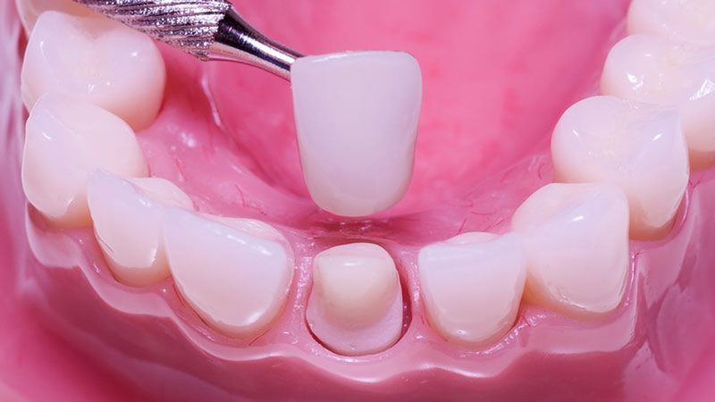 nha khoa trồng răng sứ giá rẻ tốt uy tín tại Quận Tân Phú 2