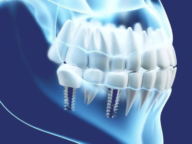 địa chỉ trồng răng implant tốt uy tín Phường Bàn Cờ TPHCM 4
