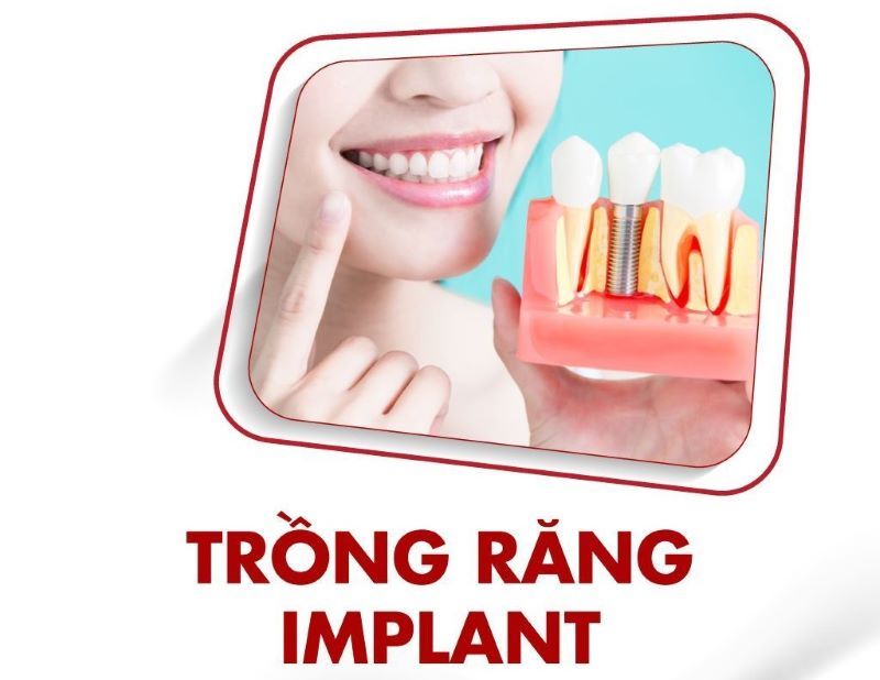 Nha khoa Dr.Care luôn tư vấn phác đồ trồng Implant theo tình trạng của khách hàng