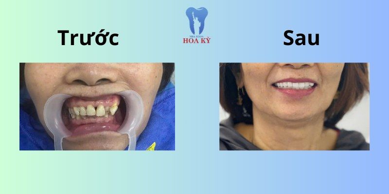 Kết quả niềng răng hoàn hảo của khách hàng tại Nha khoa Hoa Kỳ