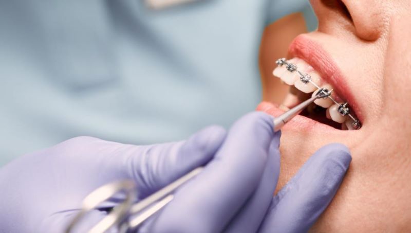 Kỹ thuật viên đang điều chỉnh mắc cài tại Nha khoa Phước An