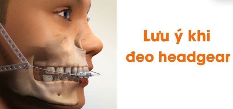 Khí cụ Headgear 7