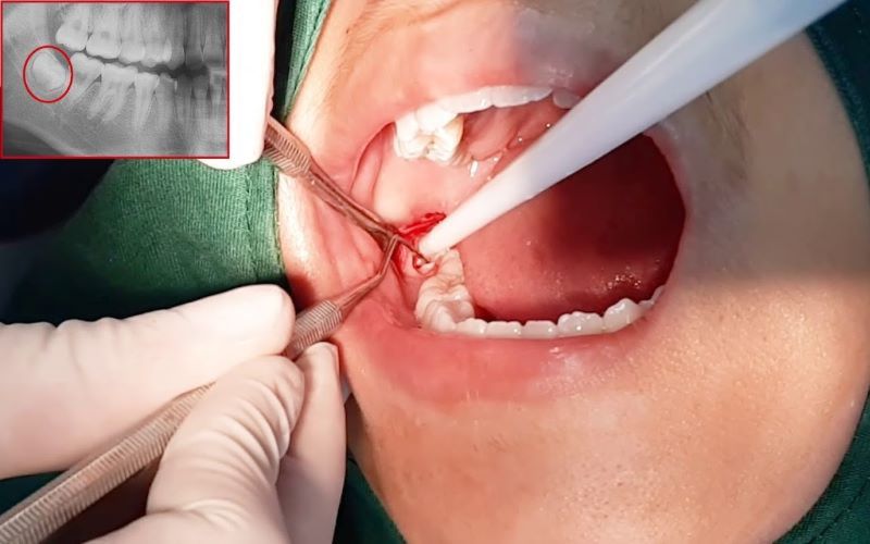 nha khoa nhổ răng khôn giá rẻ tốt uy tín Phường Tân Sơn Nhì TP HCM