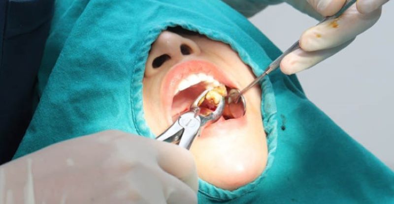 nha khoa nhổ răng khôn giá rẻ tốt uy tín Phường Tân Sơn Nhì TP HCM 2