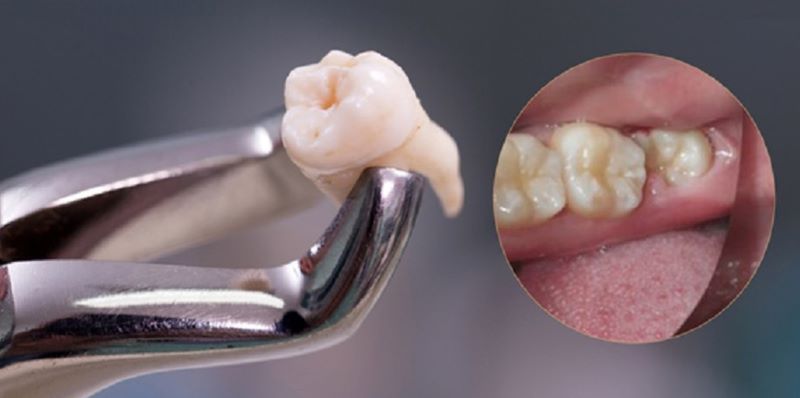 nha khoa nhổ răng khôn giá rẻ tốt uy tín Phường Tân Sơn Nhì TP HCM 6