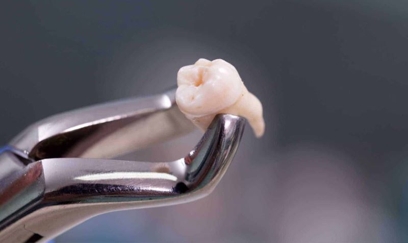 Bác sĩ Nha khoa Anh Dental thao tác nhổ răng nhẹ nhàng, chính xác