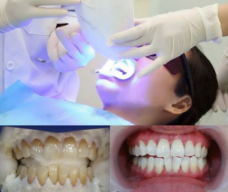 nha khoa tẩy trắng răng giá rẻ tốt uy tín Phường Tân Sơn Nhì TP HCM