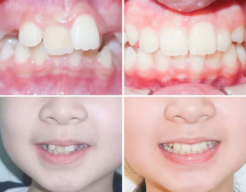 Invisalign IPE 2