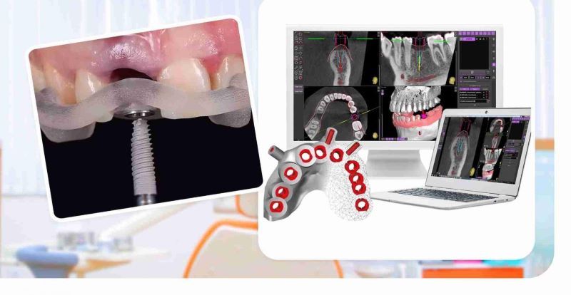 địa chỉ trồng răng implant tốt uy tín Phường Khánh Hội TPHCM 4