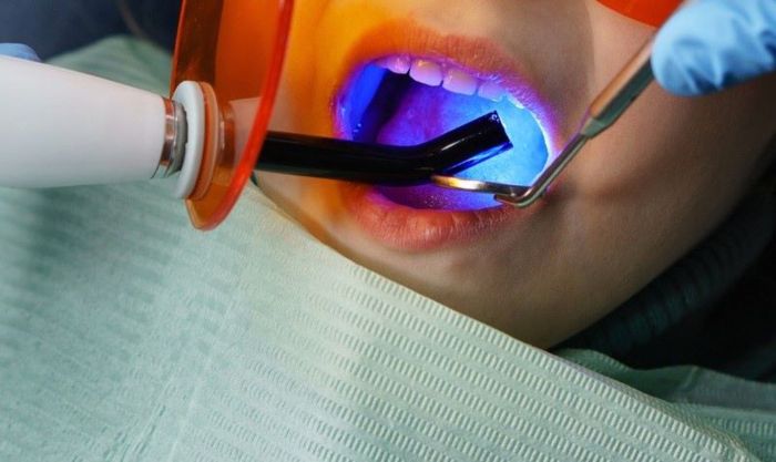 Dịch vụ trám răng giá tốt, uy tín lâu năm tại nha khoa Happy