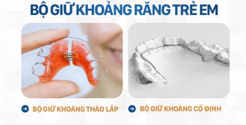 Hai loại bộ giữ khoảng cố định và tháo lắp