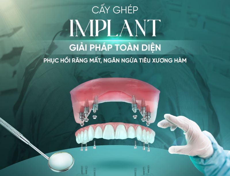 địa chỉ trồng răng implant tốt uy tín Phường Vĩnh Hội TPHCM