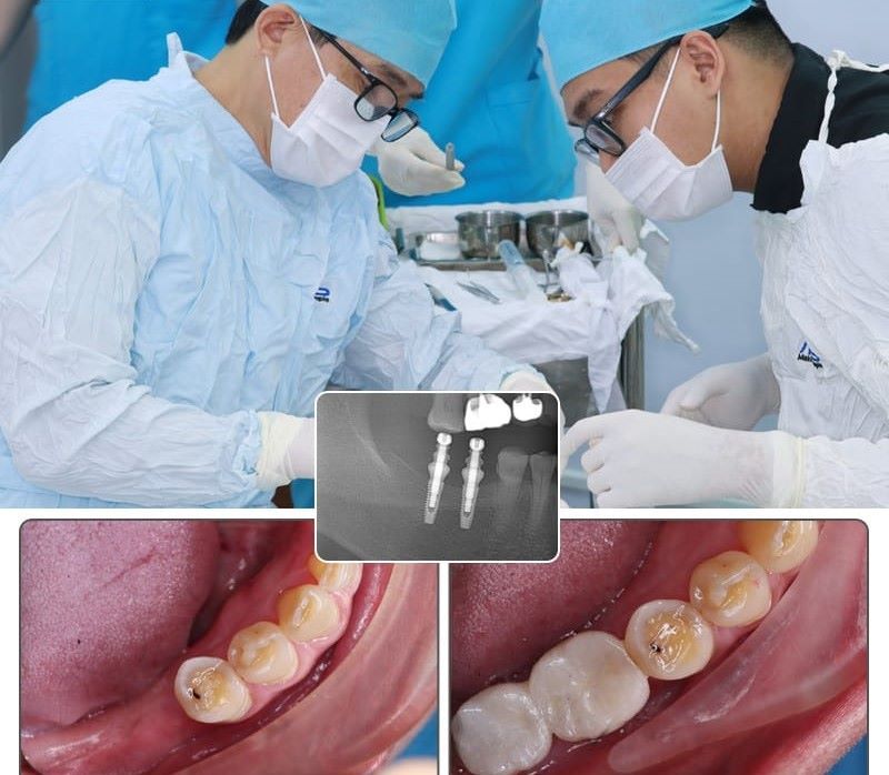 Nha Khoa Ocare xử lý Implant phức tạp tiêu xương nặng
