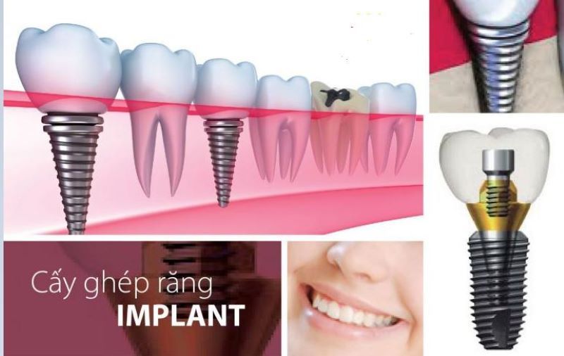 Nha khoa Viet Smile ứng dụng công nghệ trồng Implant hiện đại