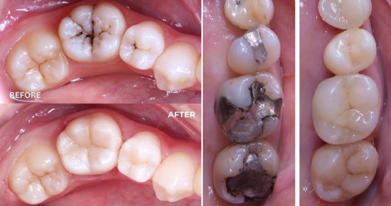 Bọc trám răng với màu tự nhiên