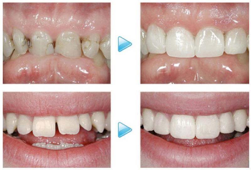 nha khoa trám răng giá rẻ tốt uy tín tại Quận 1  - 2