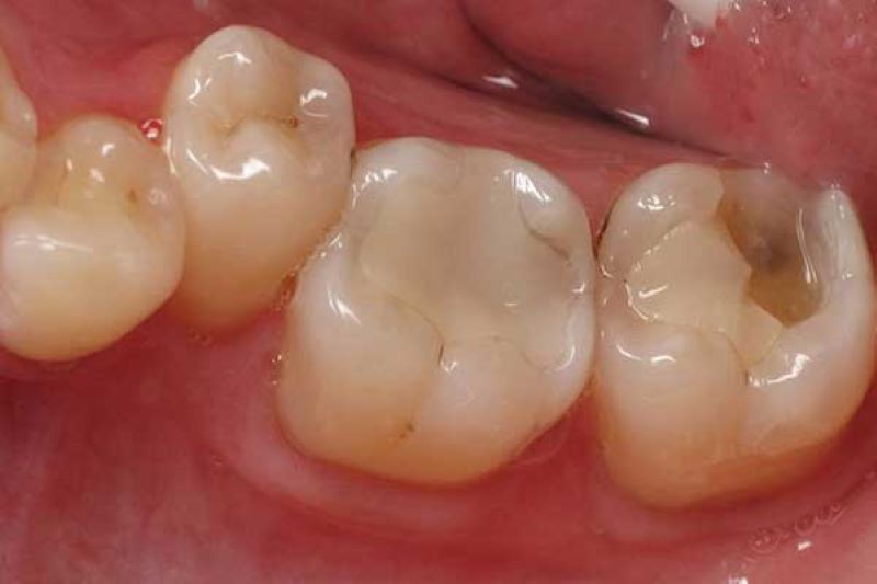 nha khoa trám răng giá rẻ tốt uy tín tại Quận 1  6