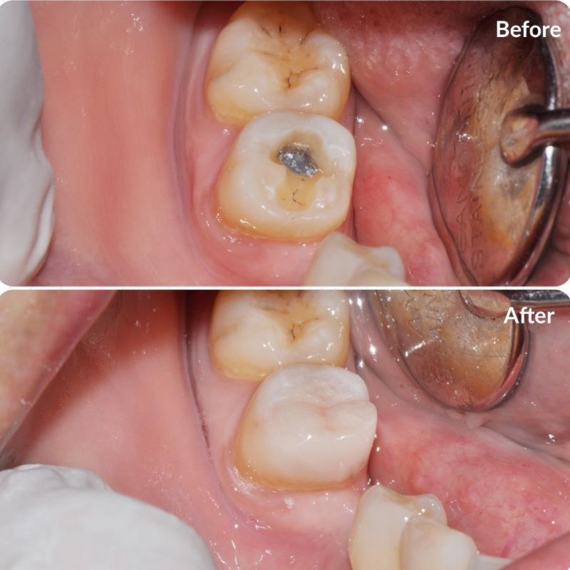 Trám răng giá tốt tại Tâm Đức Smile