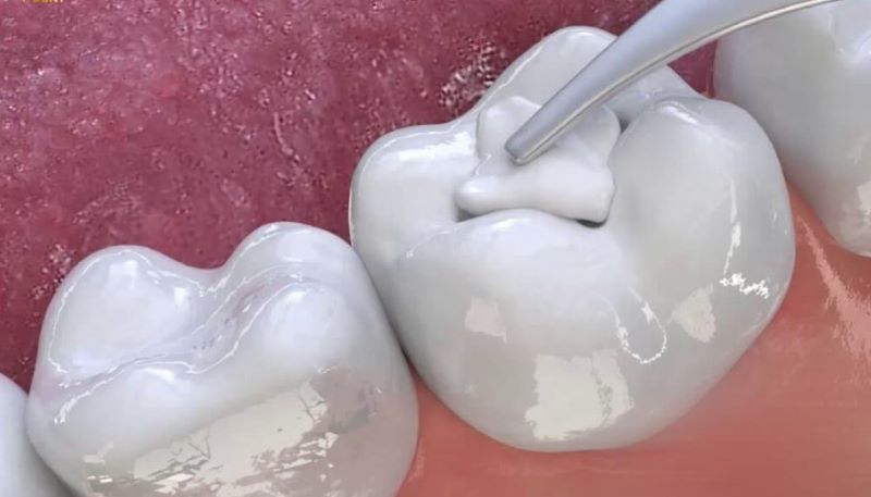 nha khoa trám răng giá rẻ tốt uy tín tại Quận Tân Phú 2