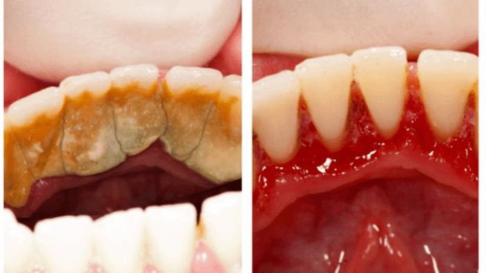 Top 7+ nha khoa cạo vôi răng giá rẻ tốt uy tín tại Bình Tân