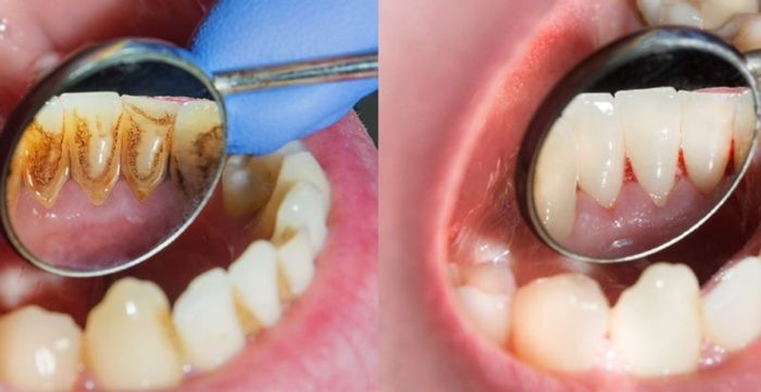 Chi nhánh nha khoa Asia ở Bình Tân có báo giá cạo vôi răng rất hấp dẫn