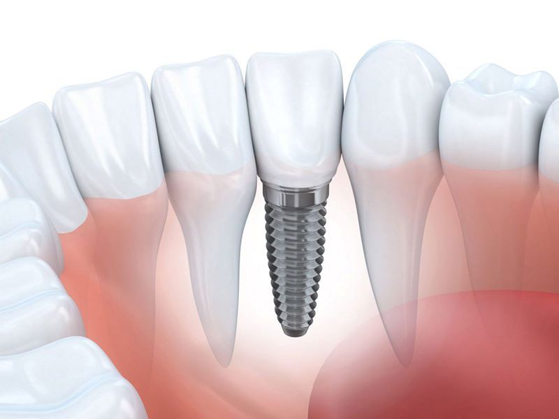 địa chỉ trồng răng implant tốt uy tín Phường Chợ Quán TPHCM