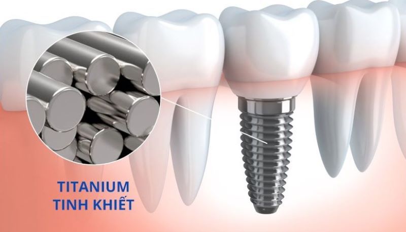 địa chỉ trồng răng implant tốt uy tín Phường Chợ Quán TPHCM 2