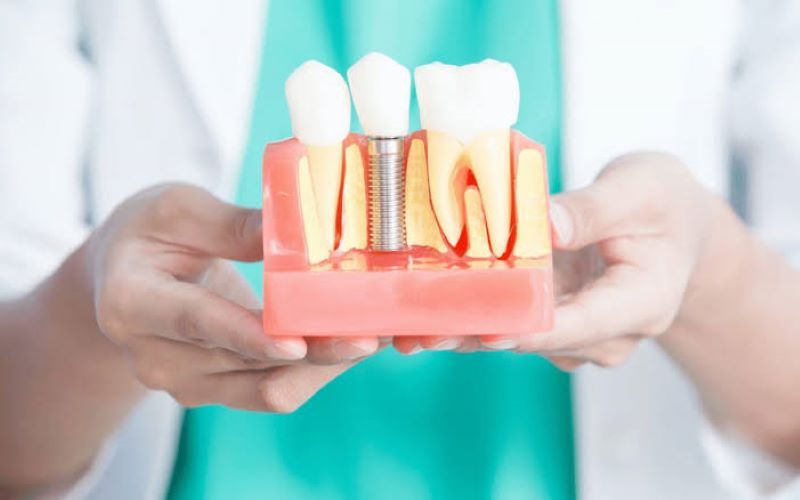 Nha khoa Đông Nam có chính sách bảo hành Implant dài hạn
