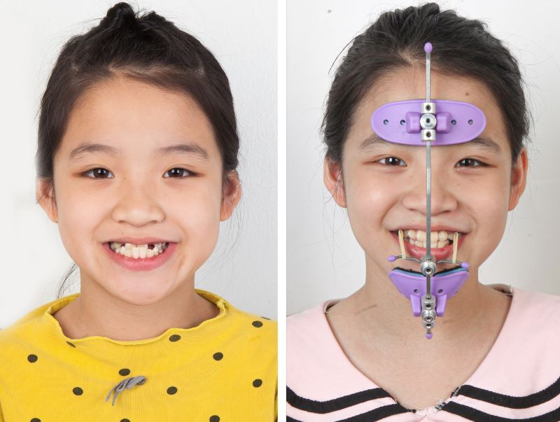 khí cụ chỉnh nha sớm cho trẻ 02