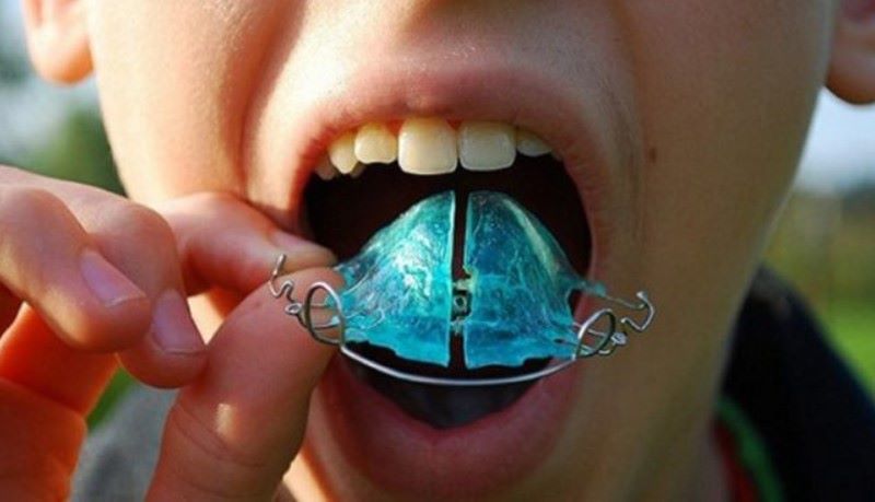 Dịch vụ chỉnh nha sớm cho trẻ tại Nha Khoa Hoa Kỳ