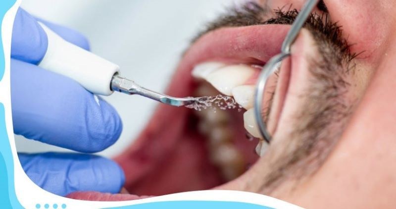 Quy trình cạo vôi chuyên nghiệp, nhẹ nhàng tại nha khoa Aden Dental 