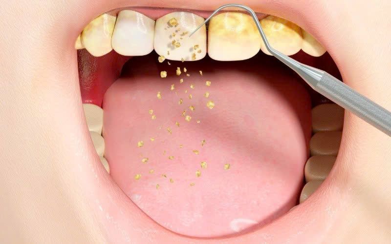 nha khoa cạo vôi răng giá rẻ tốt uy tín Phường Tân Sơn Nhì TP HCM 4