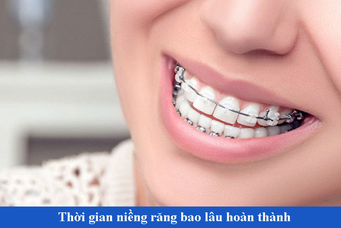 Niềng răng trong bao lâu 5