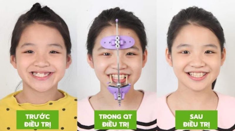 Chỉnh nha trẻ em 2