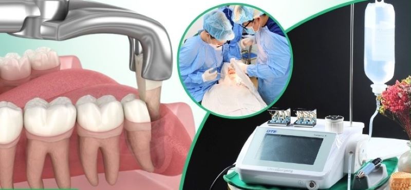 địa chỉ trồng răng implant tốt uy tín Phường An Đông TPHCM 3