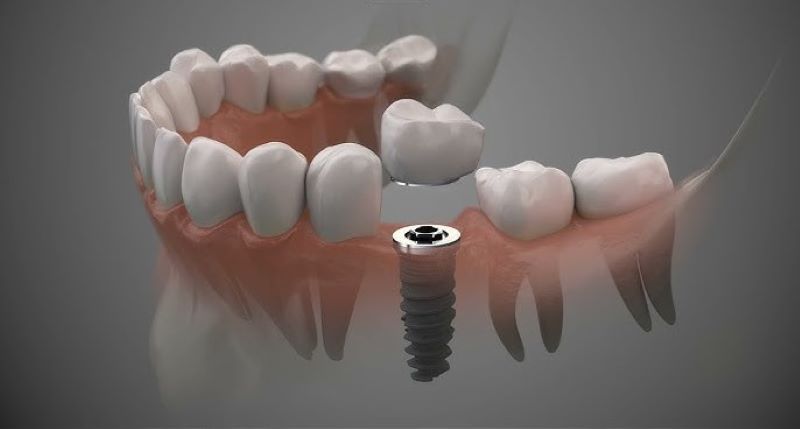 Nha Khoa Việt Smile mô phỏng Implant bằng công nghệ 3D