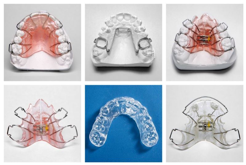 chỉnh nha sớm cho trẻ 2
