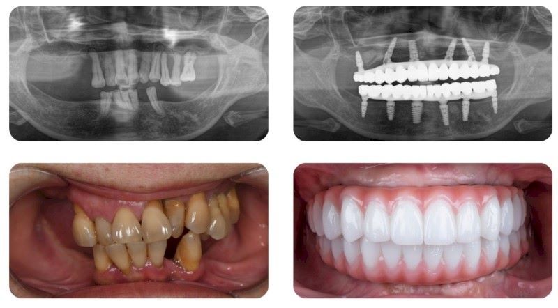 Nha khoa Nhân Tâm nổi bật với kết quả trồng implant chất lượng, an toàn cao